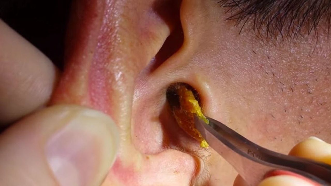 कान से वैक्स निकालने के घरेलू उपचार