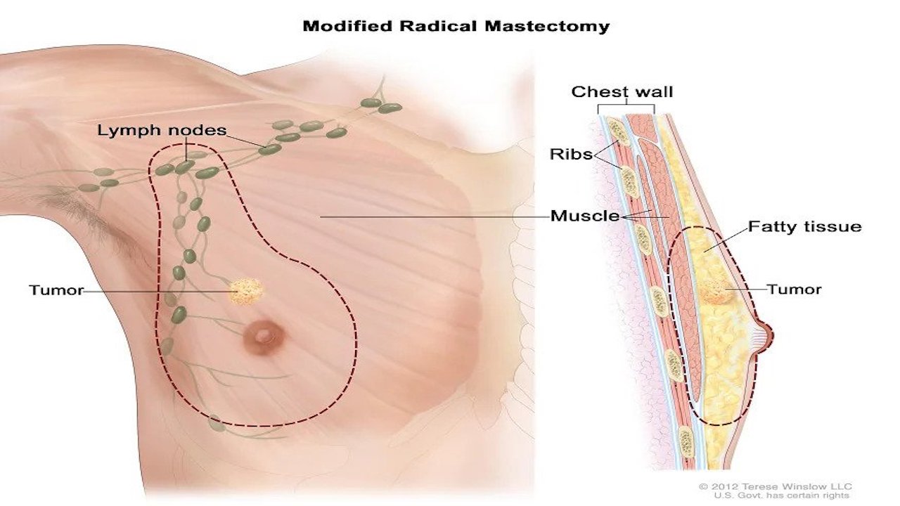 Male Breast Cancer Causes Symtoms and Treatments in Hindi